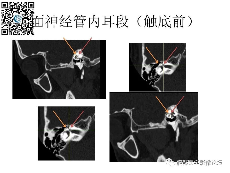 影像PPT - 【PPT】颅骨颅底系列之触底四神共一门-32