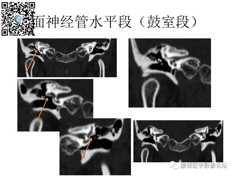 影像PPT - 【PPT】颅骨颅底系列之触底四神共一门-35