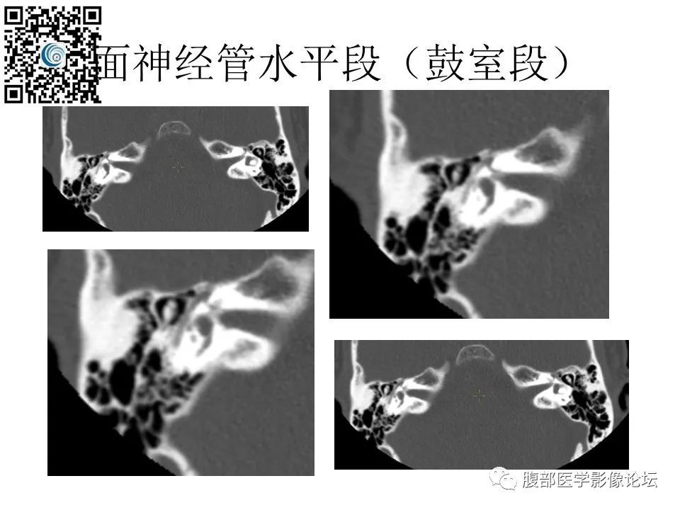 影像PPT - 【PPT】颅骨颅底系列之触底四神共一门-34
