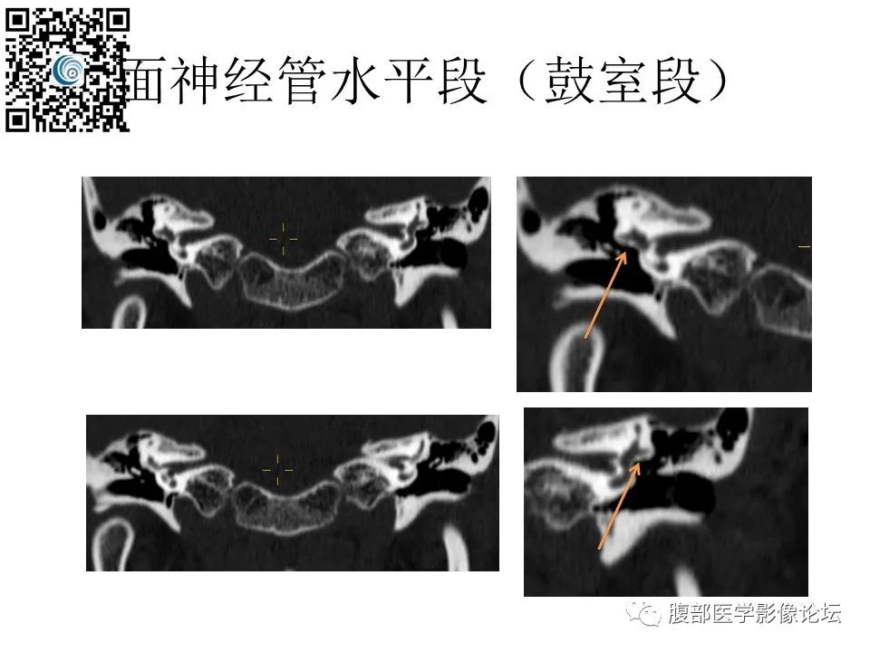 影像PPT - 【PPT】颅骨颅底系列之触底四神共一门-36