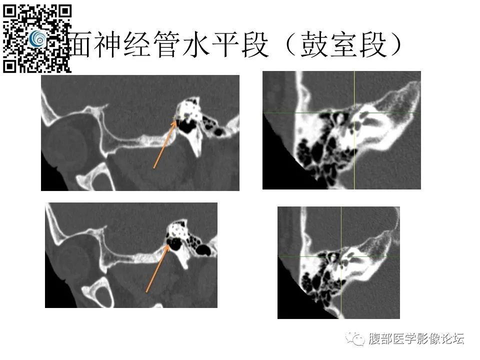 影像PPT - 【PPT】颅骨颅底系列之触底四神共一门-37
