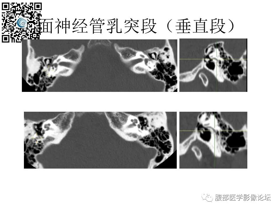 影像PPT - 【PPT】颅骨颅底系列之触底四神共一门-39
