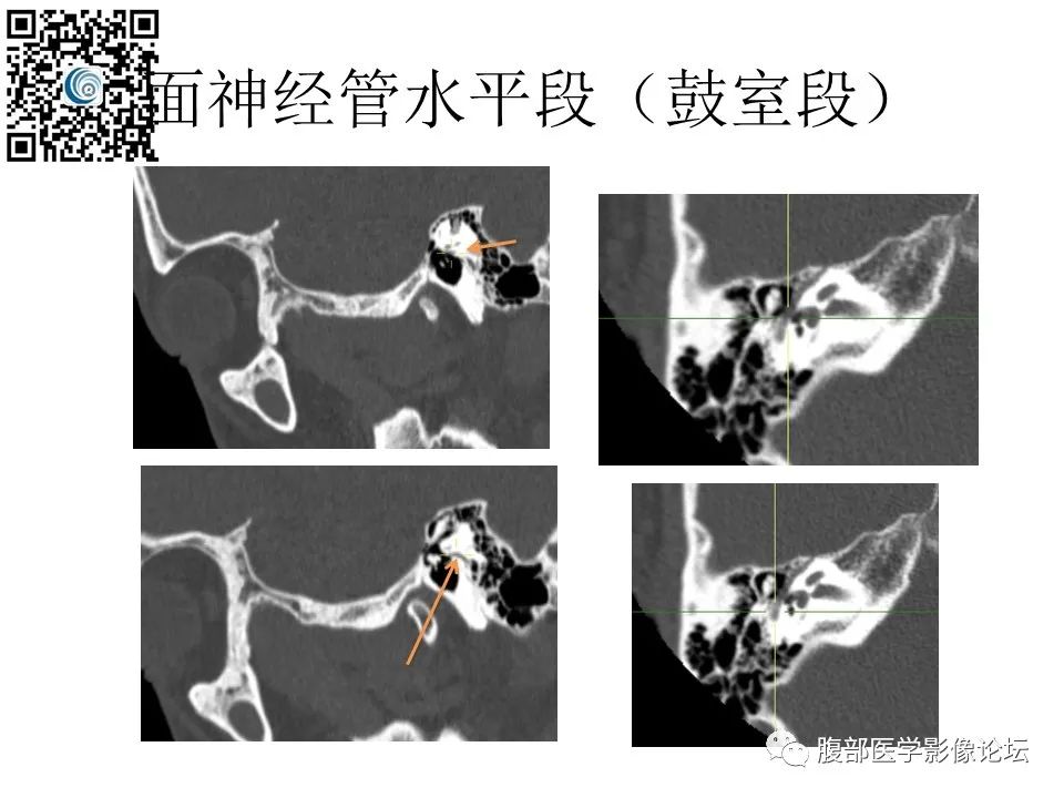 影像PPT - 【PPT】颅骨颅底系列之触底四神共一门-38