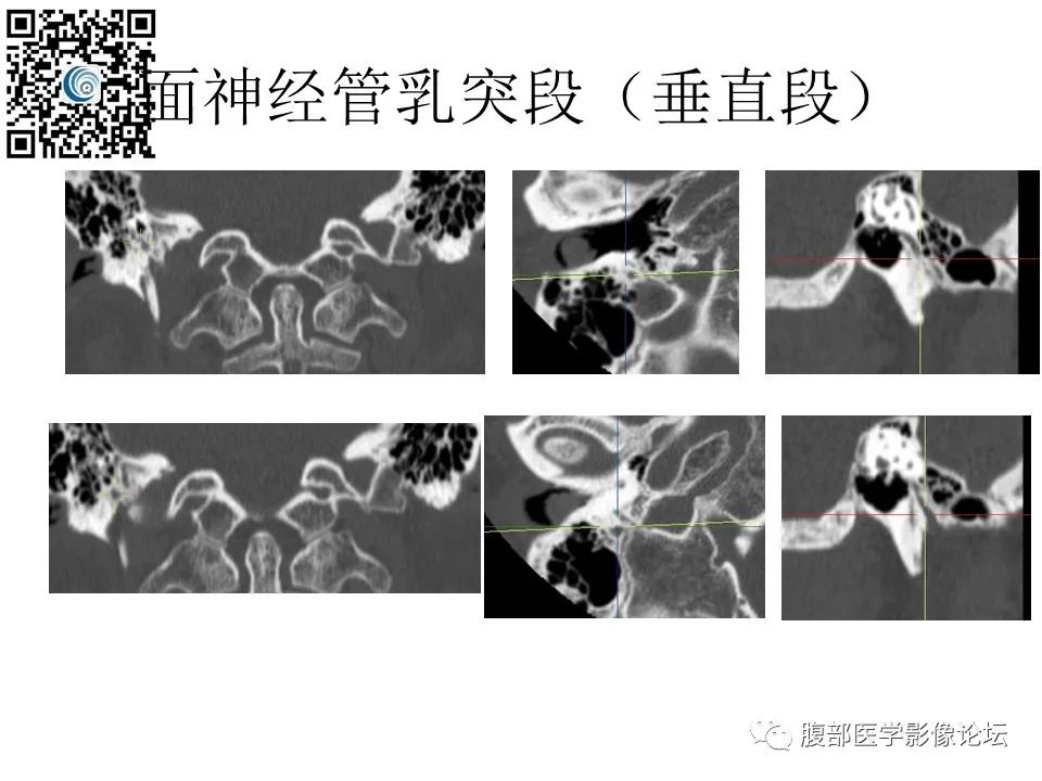 影像PPT - 【PPT】颅骨颅底系列之触底四神共一门-42