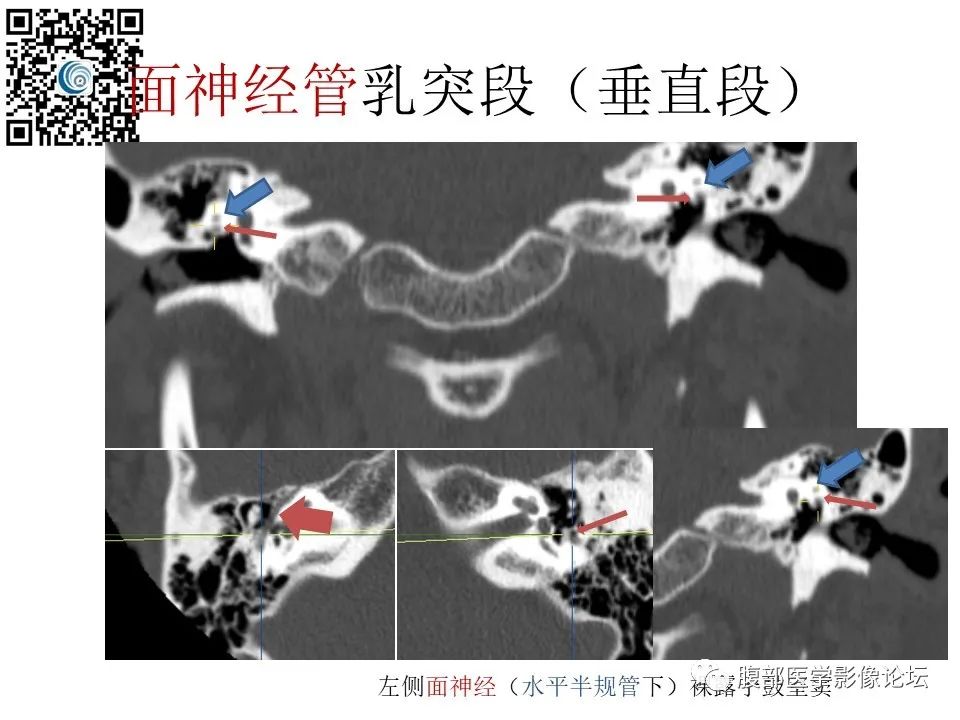 影像PPT - 【PPT】颅骨颅底系列之触底四神共一门-41