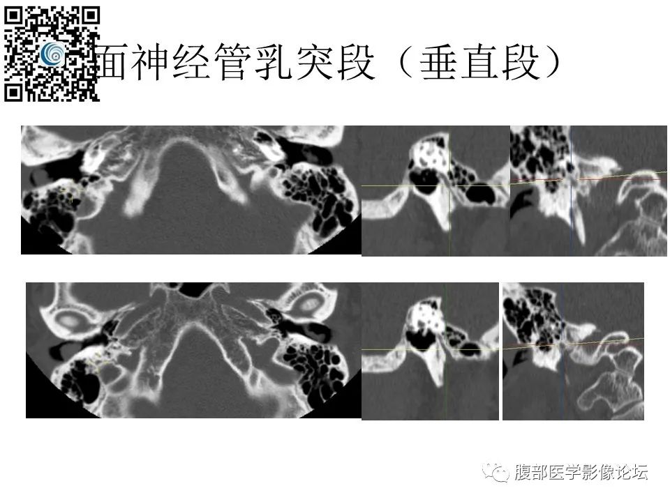 影像PPT - 【PPT】颅骨颅底系列之触底四神共一门-40