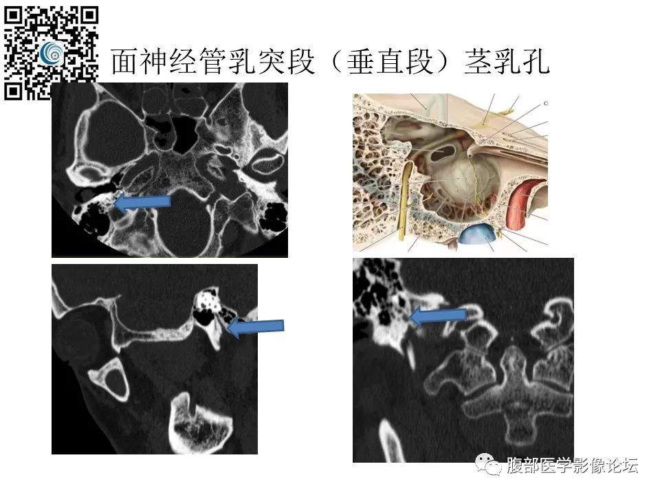影像PPT - 【PPT】颅骨颅底系列之触底四神共一门-46