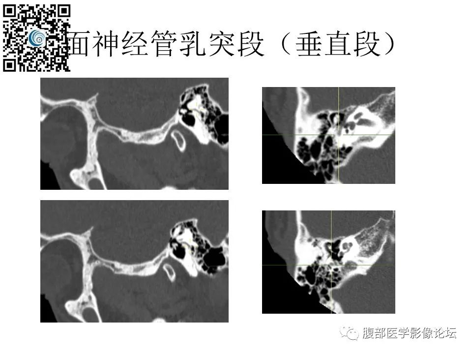 影像PPT - 【PPT】颅骨颅底系列之触底四神共一门-43