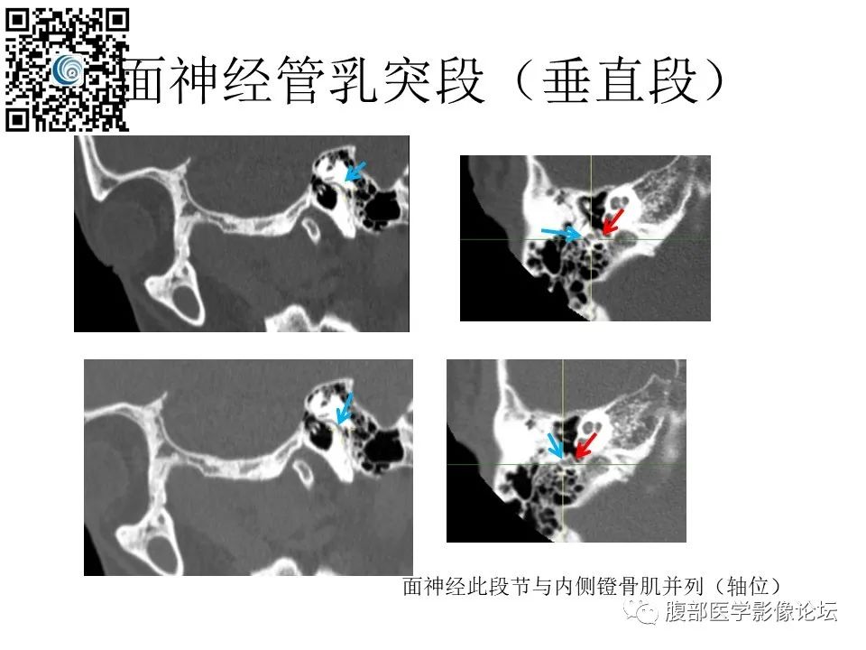 影像PPT - 【PPT】颅骨颅底系列之触底四神共一门-44