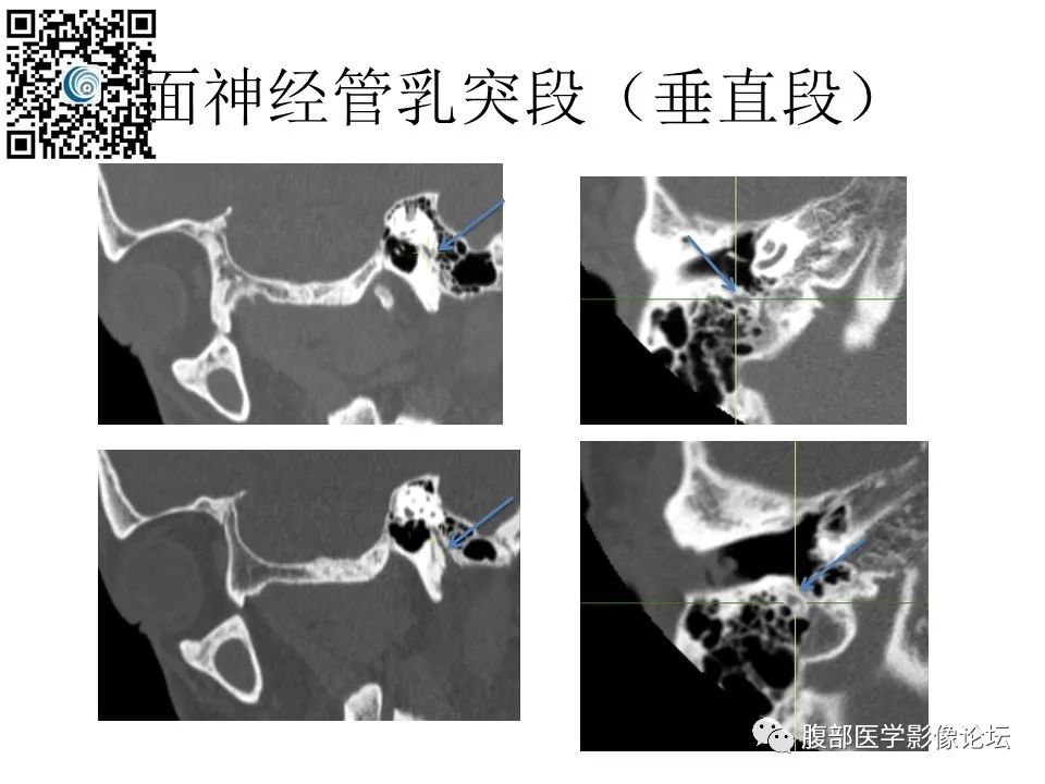 影像PPT - 【PPT】颅骨颅底系列之触底四神共一门-45