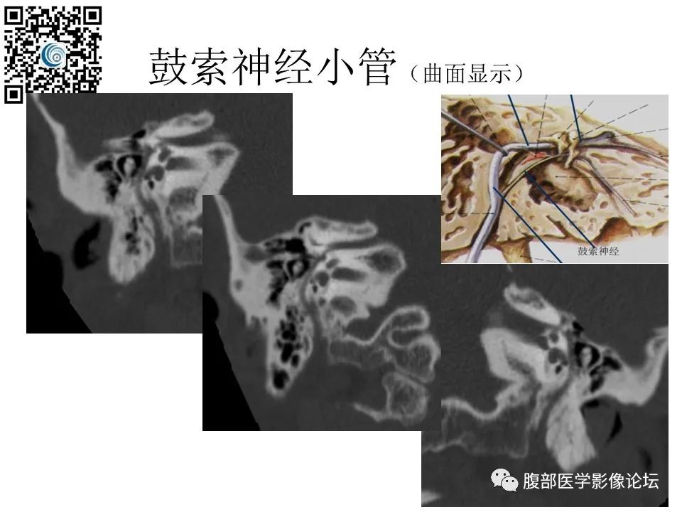 影像PPT - 【PPT】颅骨颅底系列之触底四神共一门-48