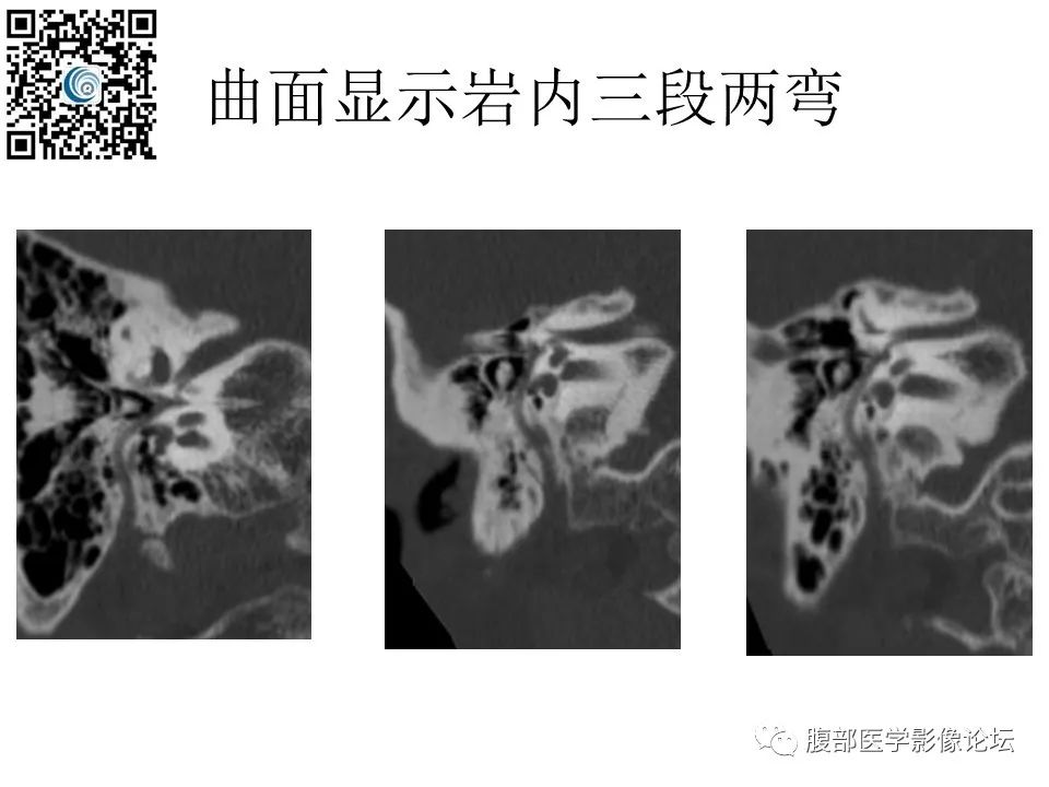 影像PPT - 【PPT】颅骨颅底系列之触底四神共一门-47