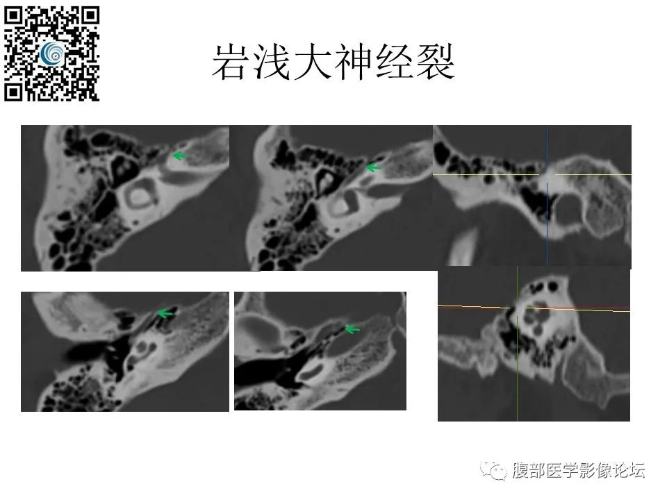 影像PPT - 【PPT】颅骨颅底系列之触底四神共一门-51