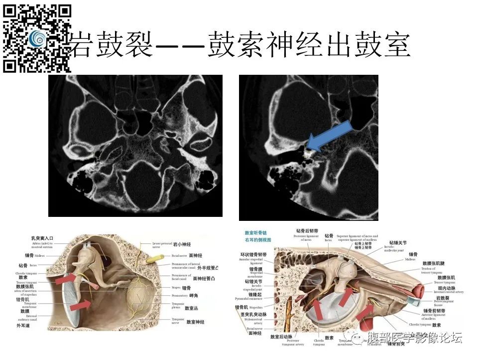 影像PPT - 【PPT】颅骨颅底系列之触底四神共一门-50