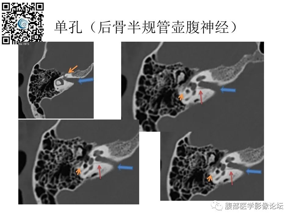 影像PPT - 【PPT】颅骨颅底系列之触底四神共一门-54