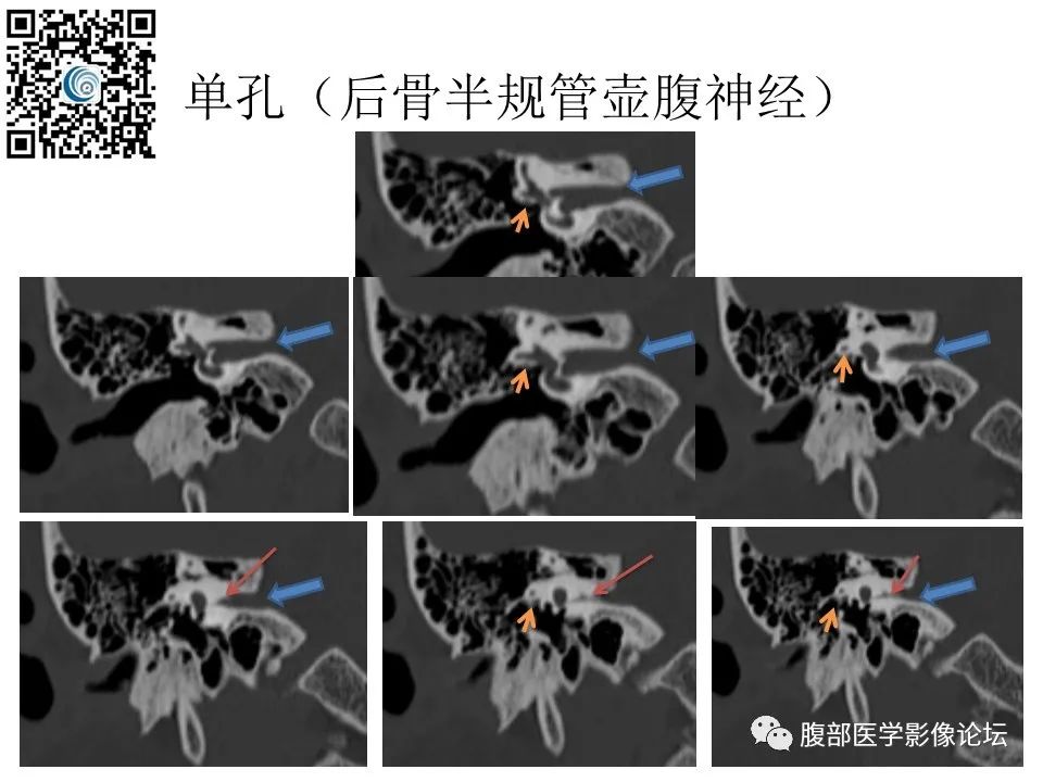 影像PPT - 【PPT】颅骨颅底系列之触底四神共一门-55