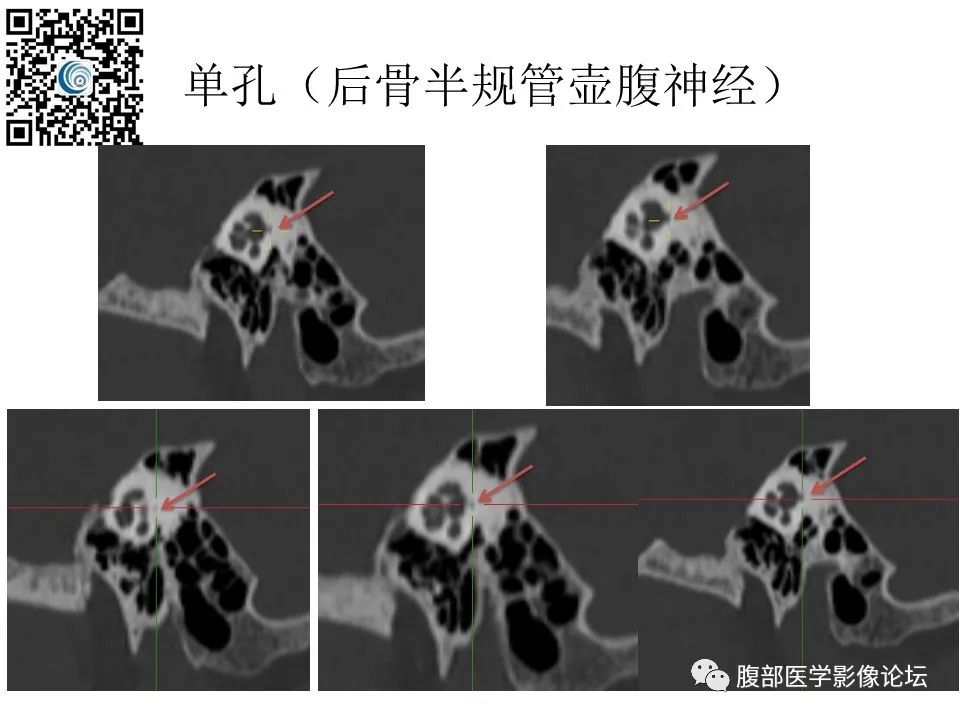 影像PPT - 【PPT】颅骨颅底系列之触底四神共一门-56