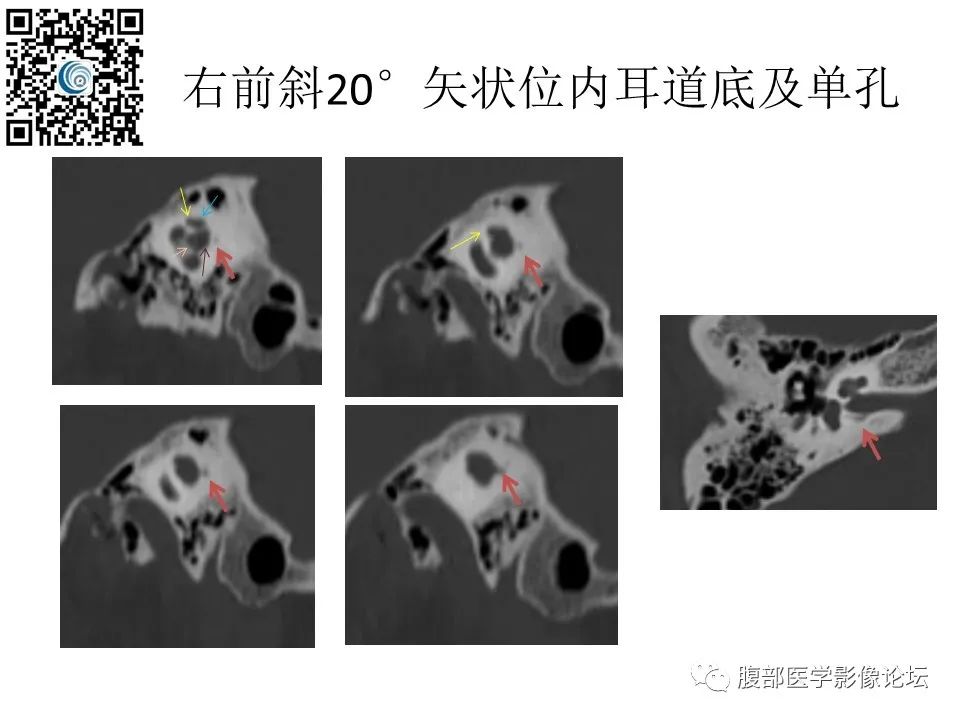 影像PPT - 【PPT】颅骨颅底系列之触底四神共一门-58