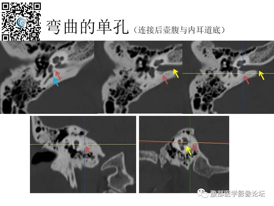 影像PPT - 【PPT】颅骨颅底系列之触底四神共一门-57