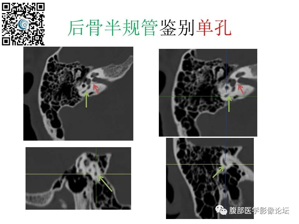 影像PPT - 【PPT】颅骨颅底系列之触底四神共一门-59