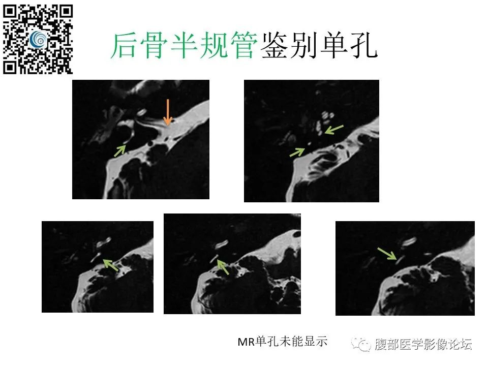 影像PPT - 【PPT】颅骨颅底系列之触底四神共一门-60