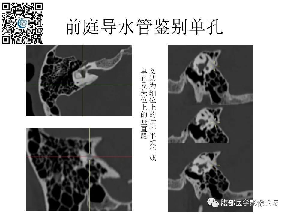 影像PPT - 【PPT】颅骨颅底系列之触底四神共一门-61