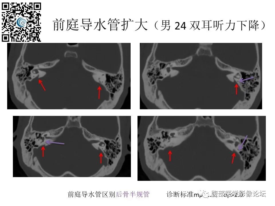 影像PPT - 【PPT】颅骨颅底系列之触底四神共一门-63