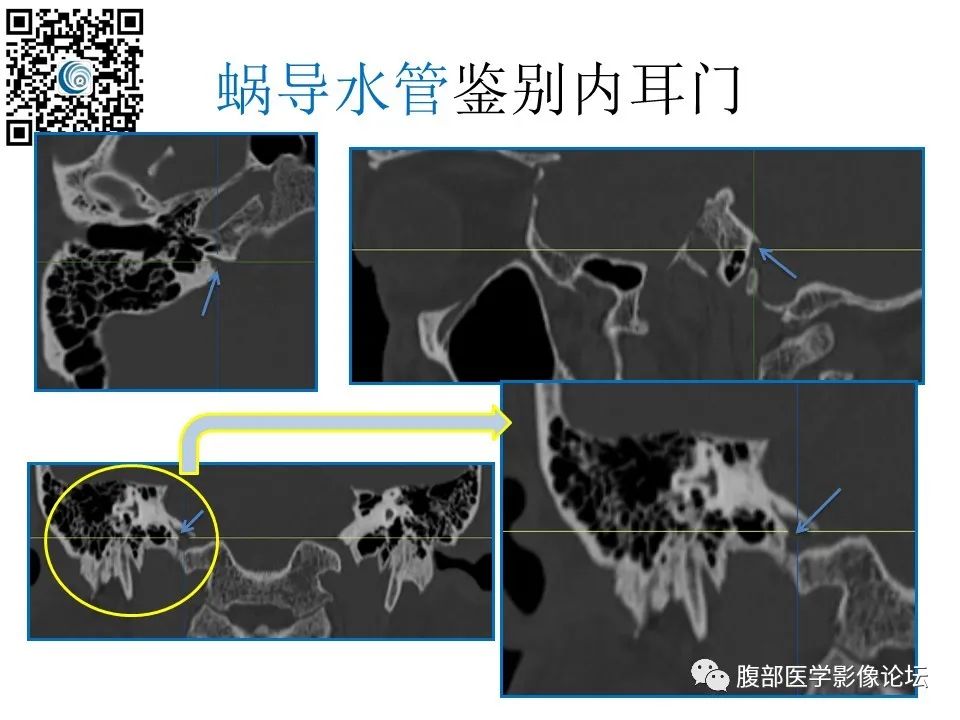 影像PPT - 【PPT】颅骨颅底系列之触底四神共一门-64