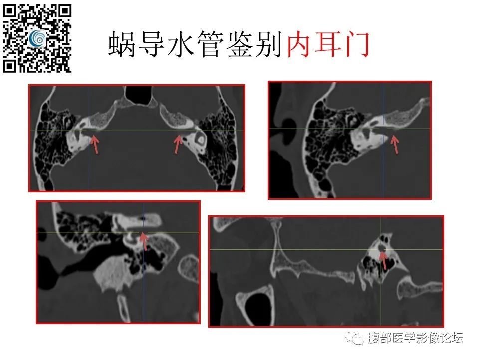 影像PPT - 【PPT】颅骨颅底系列之触底四神共一门-65
