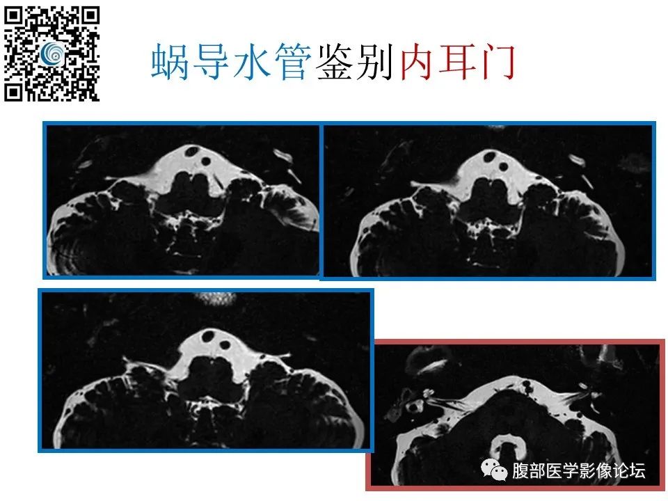 影像PPT - 【PPT】颅骨颅底系列之触底四神共一门-66