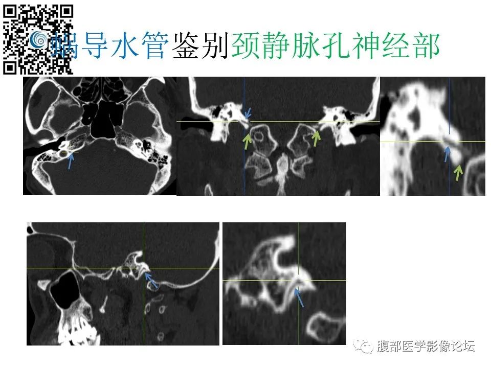 影像PPT - 【PPT】颅骨颅底系列之触底四神共一门-67
