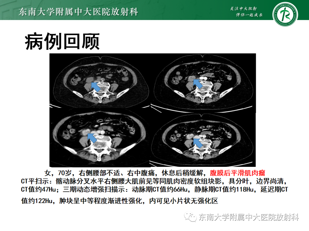 影像PPT - 【PPT】腹膜后平滑肌肉瘤的影像-2