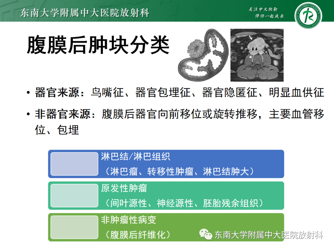 影像PPT - 【PPT】腹膜后平滑肌肉瘤的影像-5