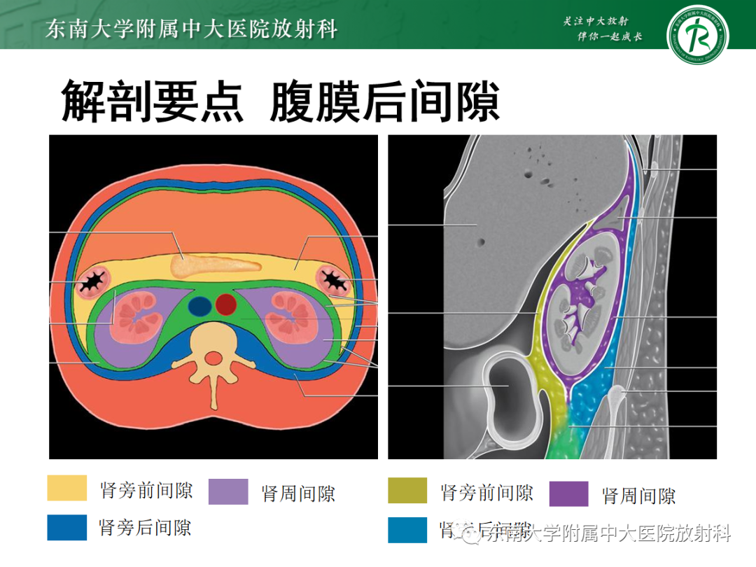 影像PPT - 【PPT】腹膜后平滑肌肉瘤的影像-4