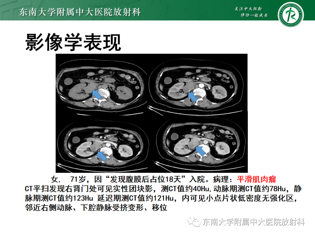 影像PPT - 【PPT】腹膜后平滑肌肉瘤的影像-10