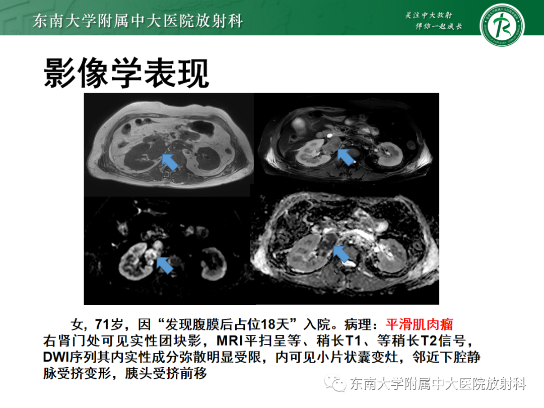 影像PPT - 【PPT】腹膜后平滑肌肉瘤的影像-11
