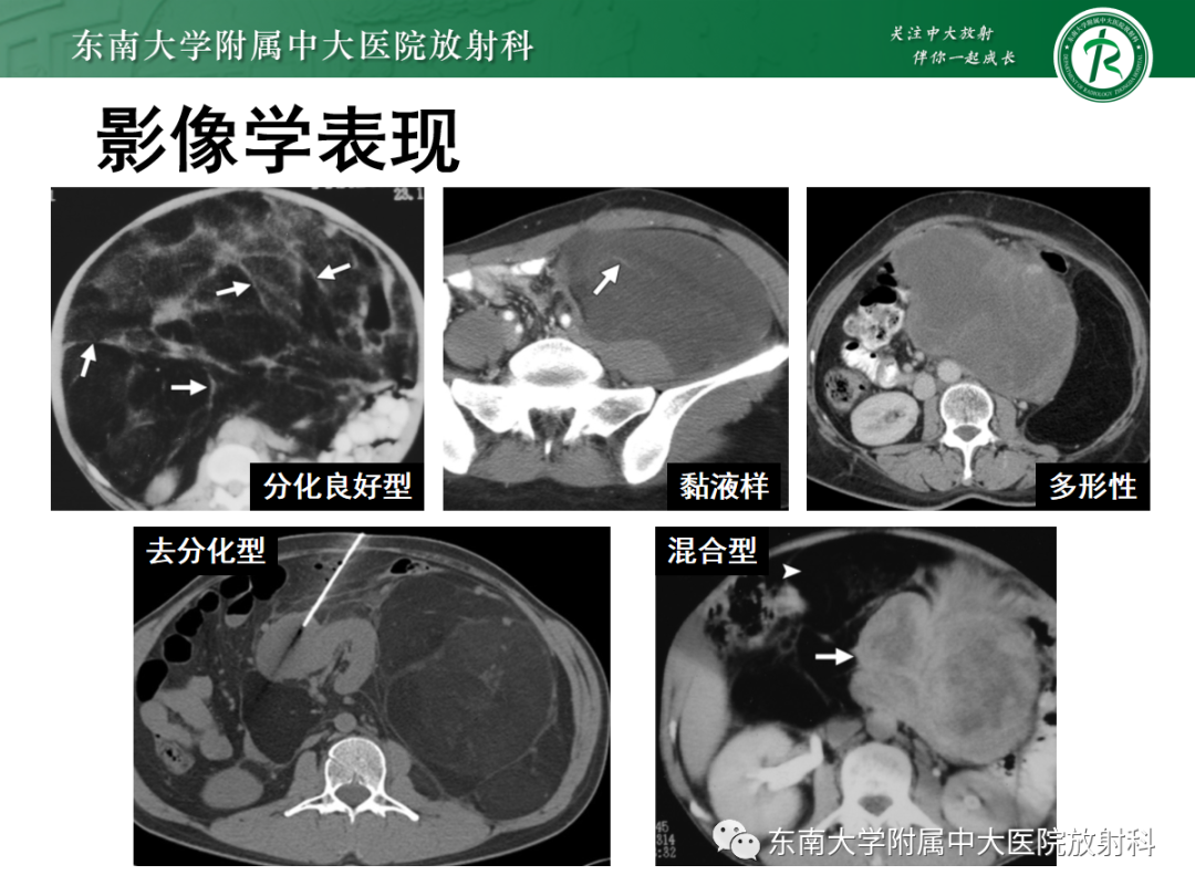 影像PPT - 【PPT】腹膜后平滑肌肉瘤的影像-13