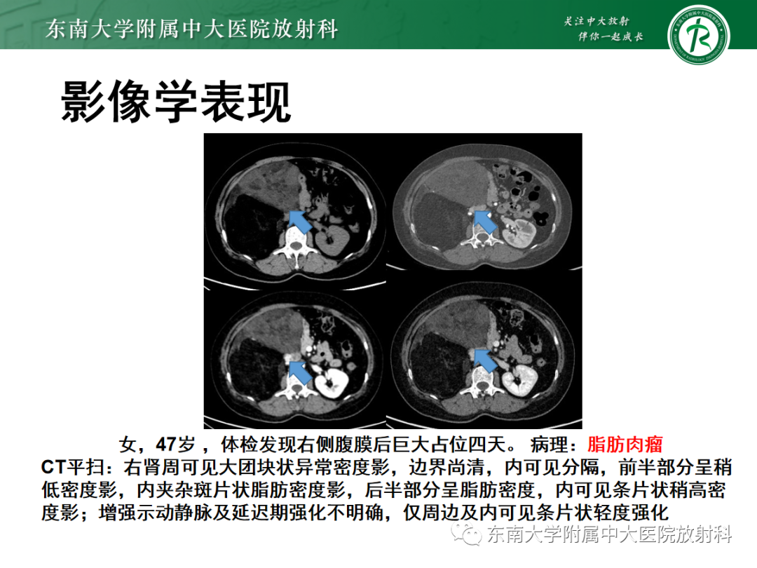 影像PPT - 【PPT】腹膜后平滑肌肉瘤的影像-14