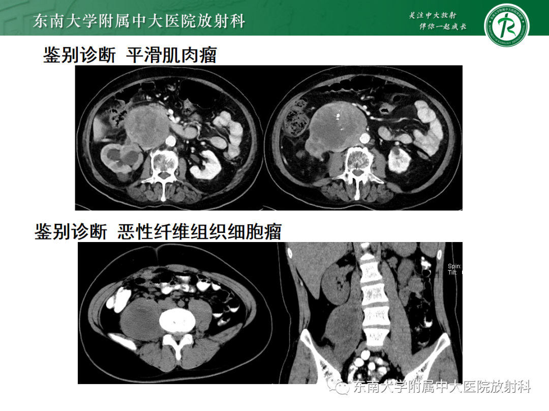 影像PPT - 【PPT】腹膜后平滑肌肉瘤的影像-16