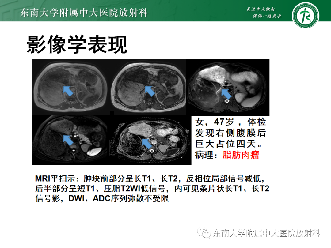 影像PPT - 【PPT】腹膜后平滑肌肉瘤的影像-15