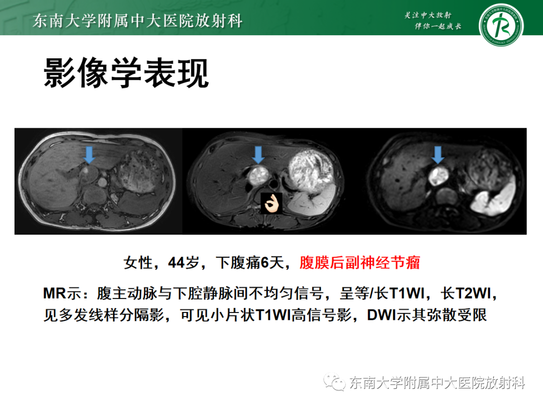 影像PPT - 【PPT】腹膜后平滑肌肉瘤的影像-19