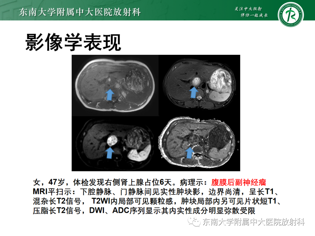 影像PPT - 【PPT】腹膜后平滑肌肉瘤的影像-20