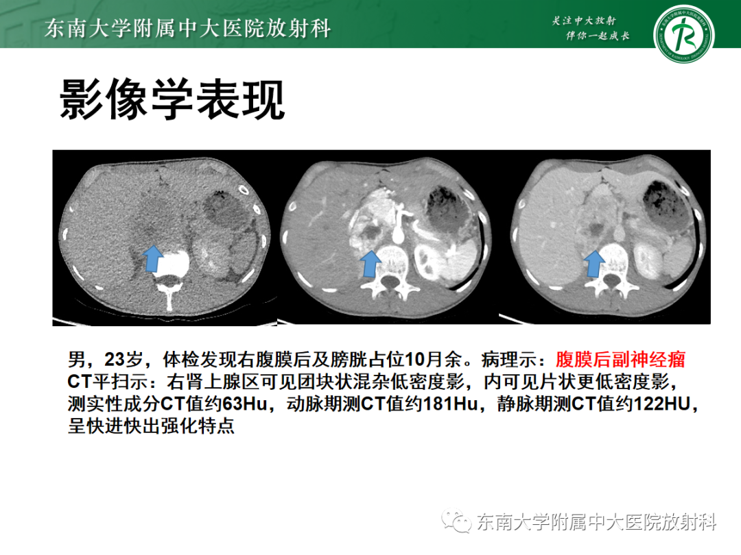 影像PPT - 【PPT】腹膜后平滑肌肉瘤的影像-21