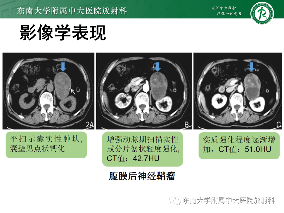 影像PPT - 【PPT】腹膜后平滑肌肉瘤的影像-23