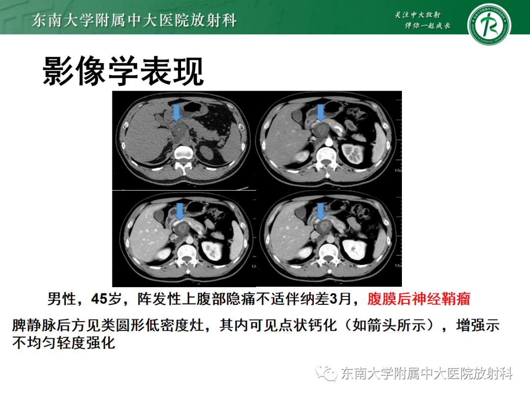 影像PPT - 【PPT】腹膜后平滑肌肉瘤的影像-24