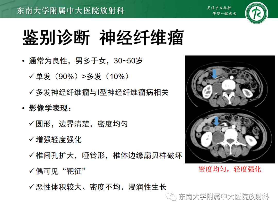 影像PPT - 【PPT】腹膜后平滑肌肉瘤的影像-25