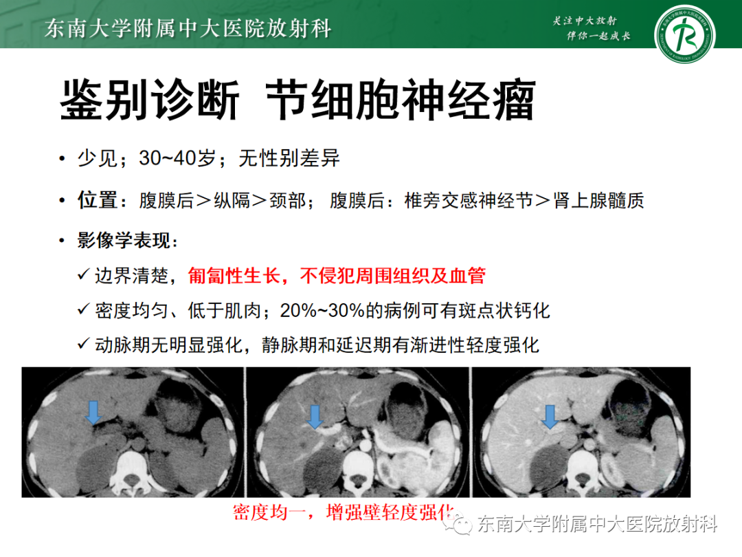 影像PPT - 【PPT】腹膜后平滑肌肉瘤的影像-26