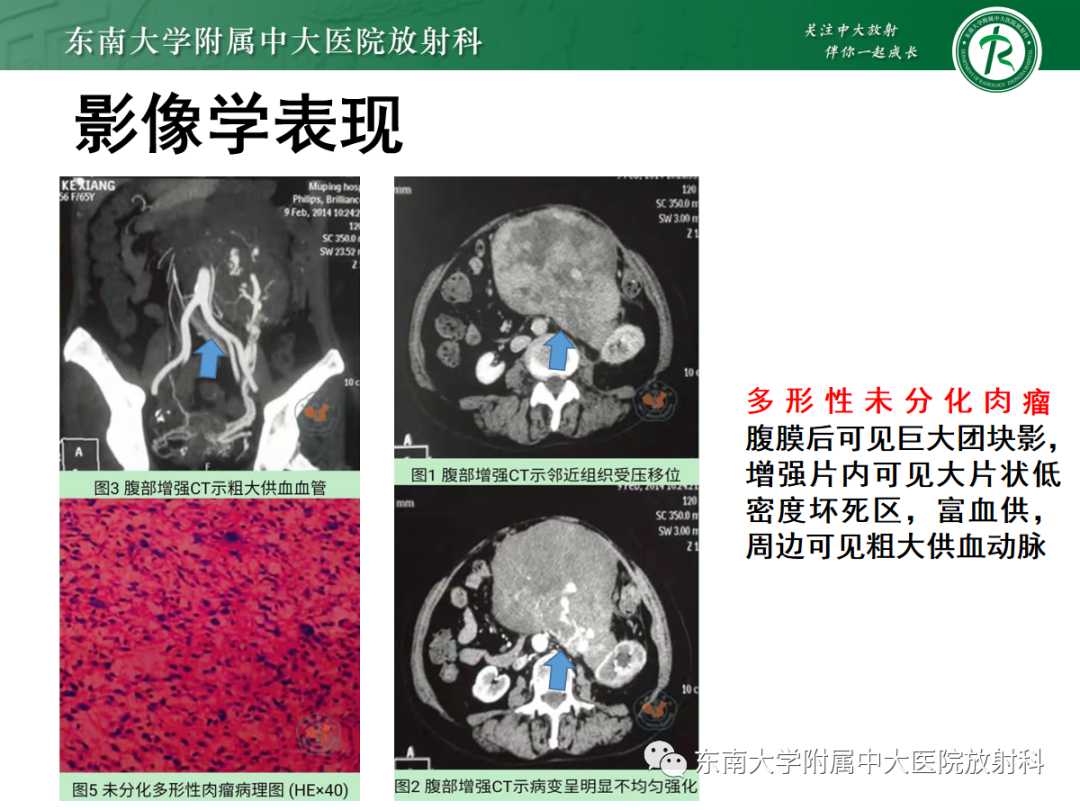 影像PPT - 【PPT】腹膜后平滑肌肉瘤的影像-28