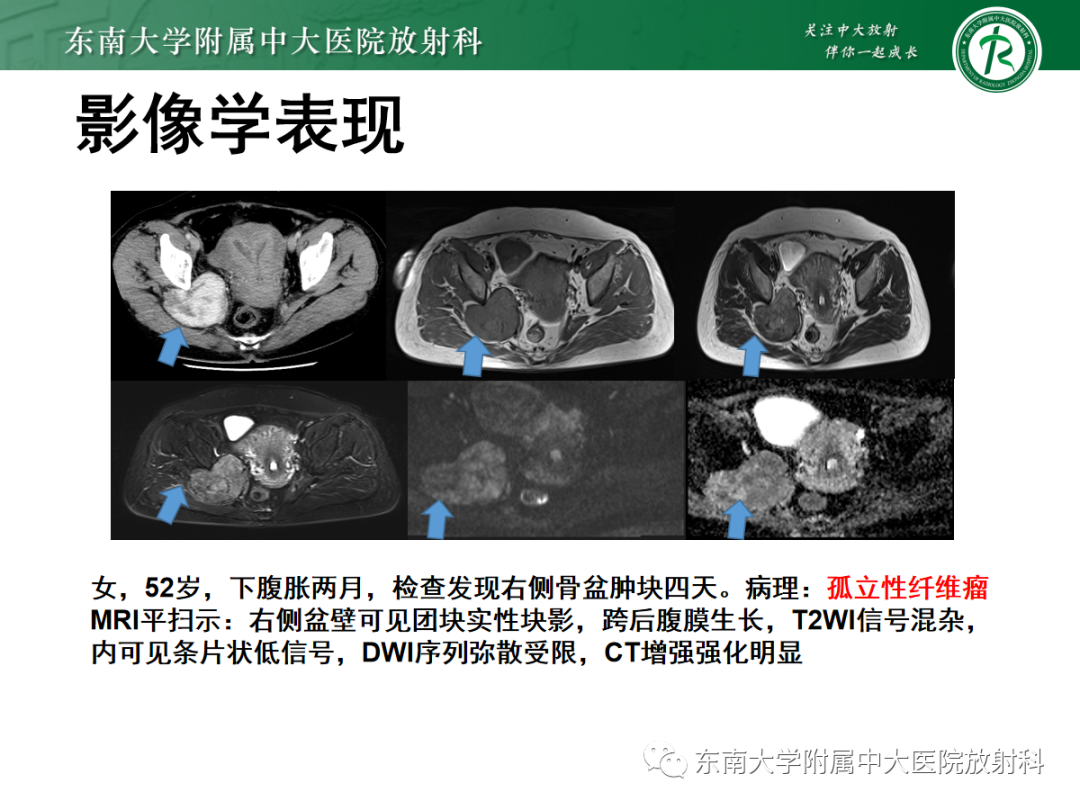 影像PPT - 【PPT】腹膜后平滑肌肉瘤的影像-30