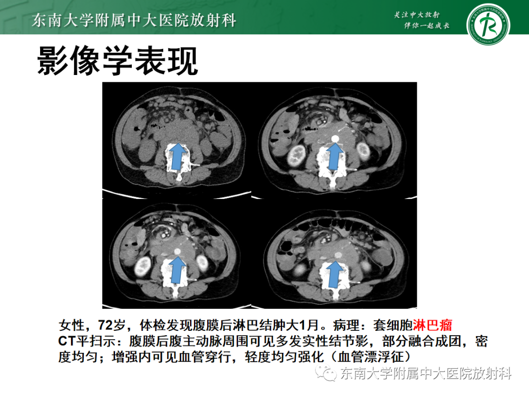 影像PPT - 【PPT】腹膜后平滑肌肉瘤的影像-32